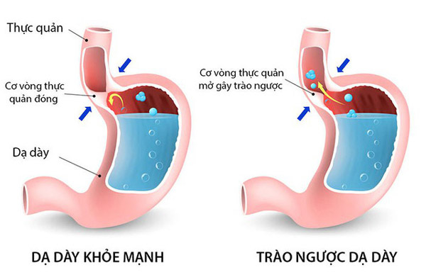 Trào ngược dạ dày thực quản có thể dẫn đến triệu chứng khàn tiếng nhưng không đau họng 